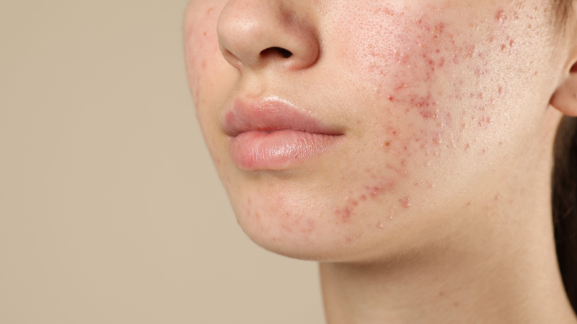 Breaking Down Breakouts: The Different Types of Acne and How to Treat Them