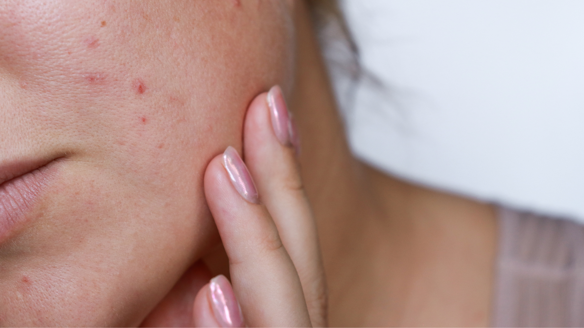Everyday Acne Care: Why Treatment Matters (and Simple Ways to Help)