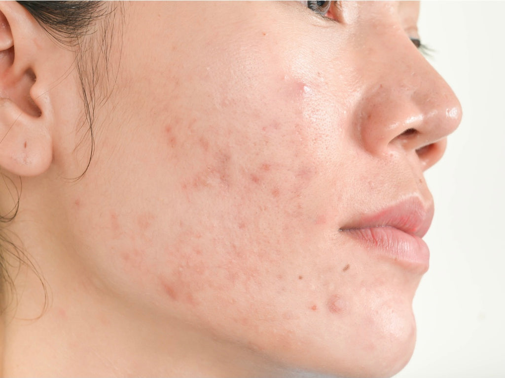 Different Types Acne: What’s Your Type?