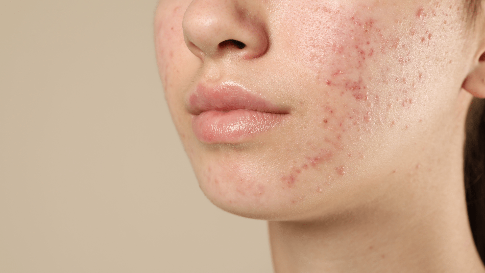 Breaking Down Breakouts: The Different Types of Acne and How to Treat Them - BEAUTYFLUFF