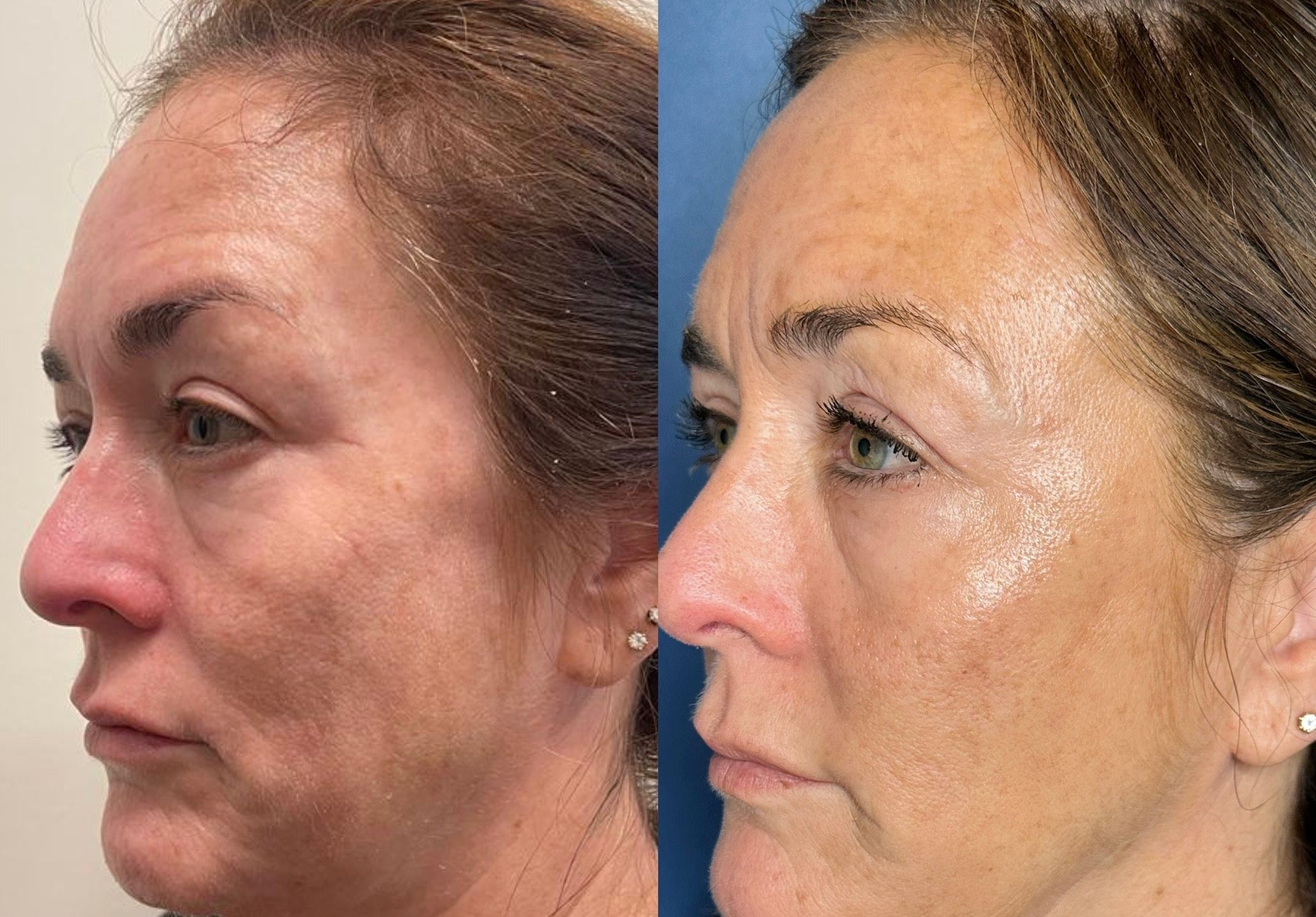 The PRP Liquid Facelift: A Natural Way to Lift Your Skin